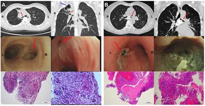 Analysis of clinical characteristics of 617 patients with benign airway stenosis